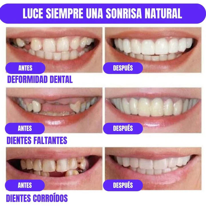 DentalGlow® Carillas de Resina para una Sonrisa Natural 